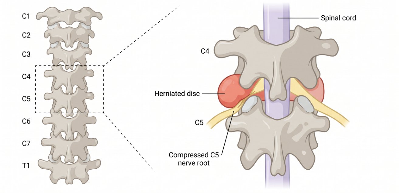 AI-generated draft of a C4–C5 disc herniation with anatomical errors