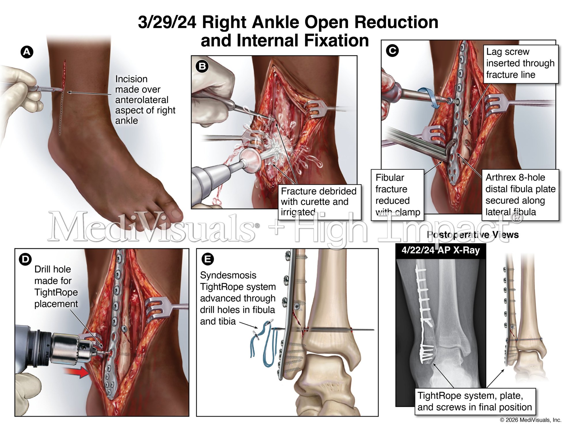 Exhibit: open reduction and internal fixation of the right ankle in five steps with postoperative X-ray
