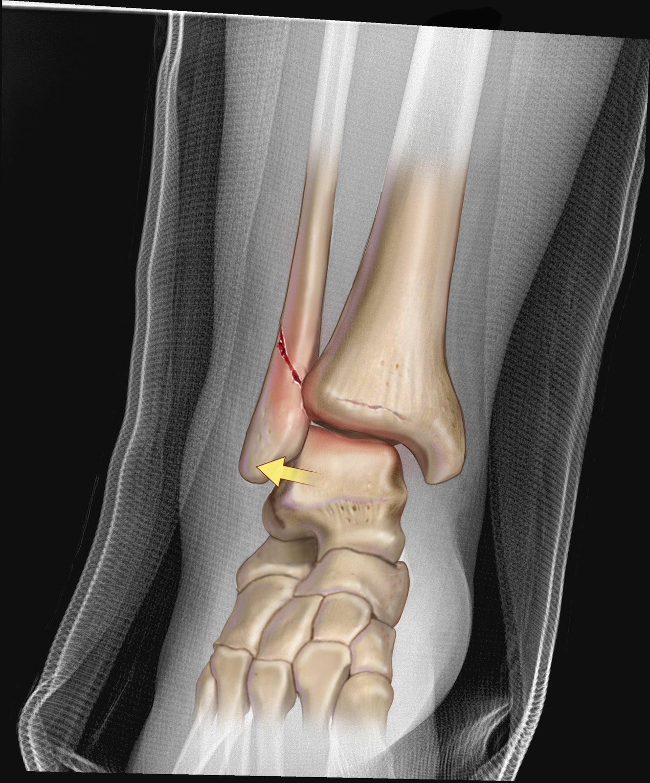 Anterior ankle with a spiral fibula fracture and talar dislocation, illustrated over the patient's X-ray