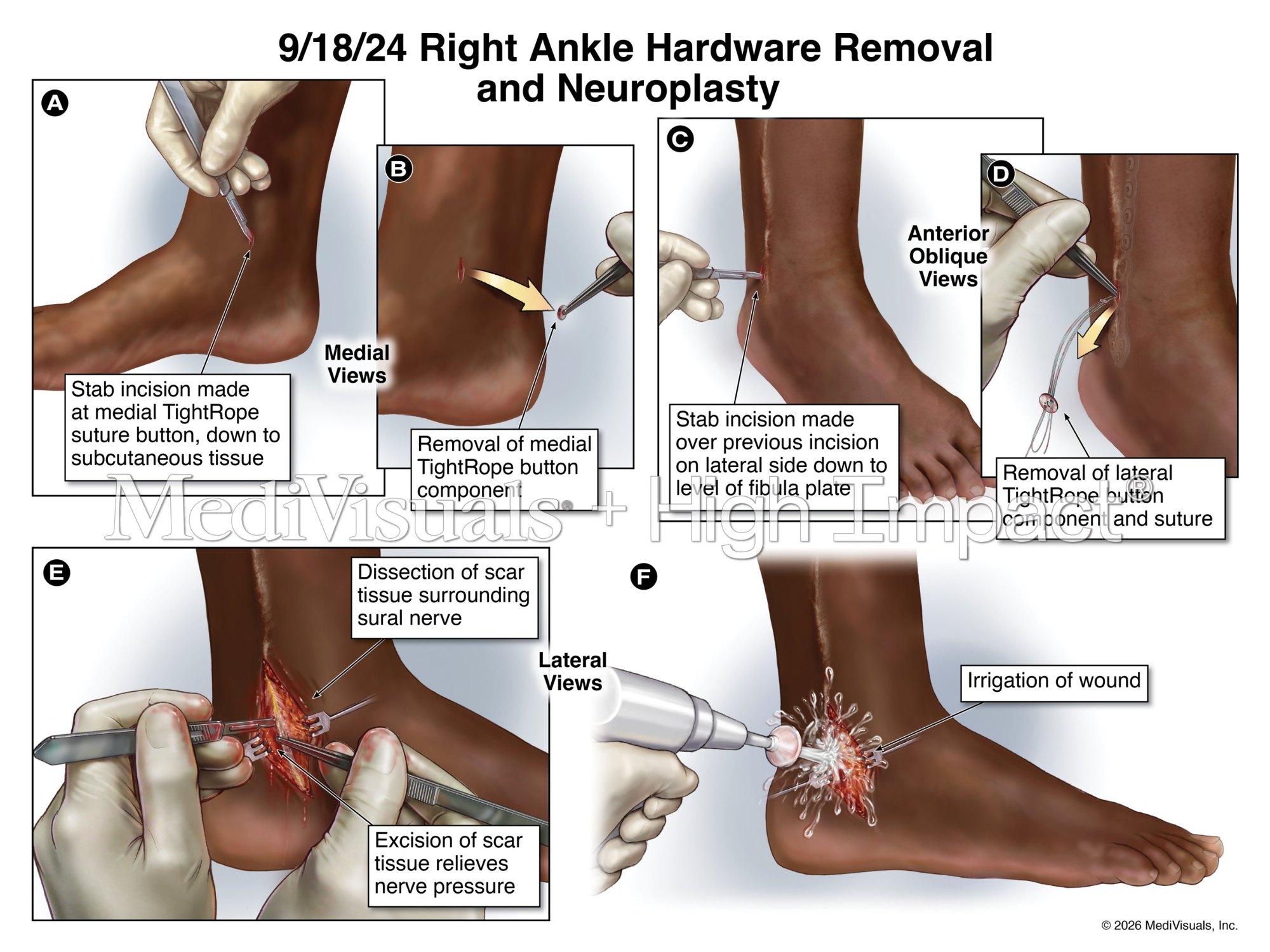 Exhibit: hardware removal and neuroplasty of the right ankle in six steps