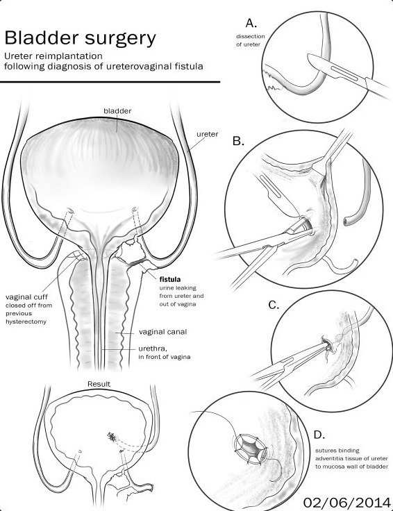 Sketch of bladder surgery, ureter reimplantation in four steps