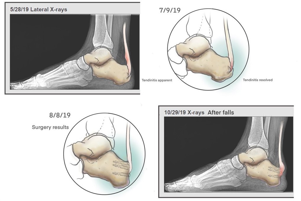 Calcaneus and Achilles tendon before and after surgery, illustrated over sequential X-rays