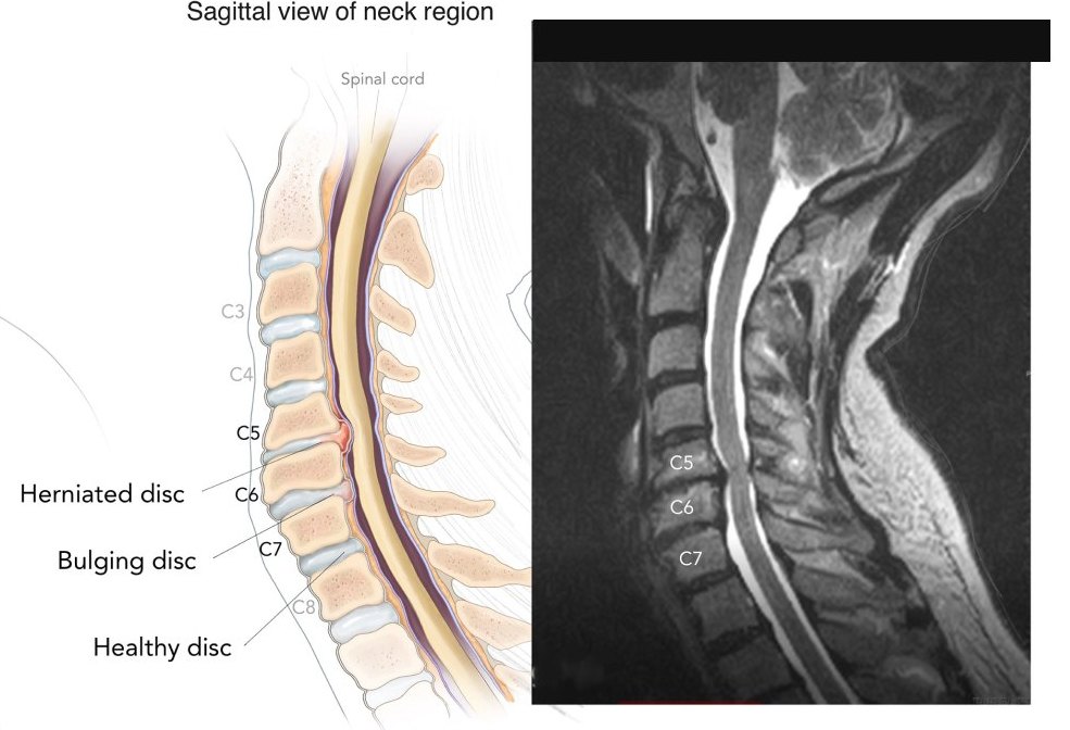 Sagittal neck illustration showing herniated and bulging discs beside an MRI