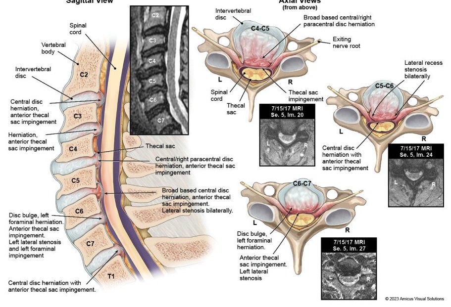 Cervical injury exhibit with sagittal and axial illustrations beside MRI slices