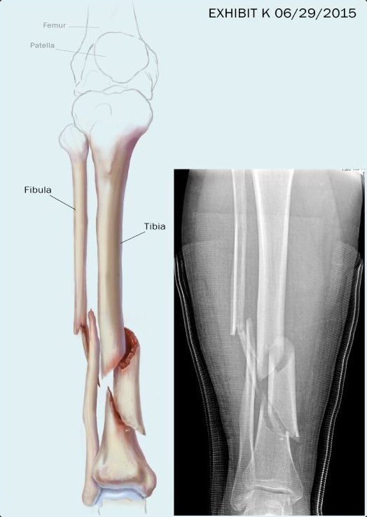 Lower leg fracture of the right tibia and fibula beside the X-ray