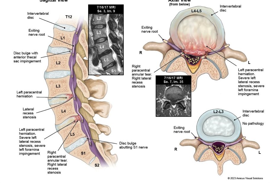 Lumbar injury exhibit with sagittal and axial illustrations beside MRI slices