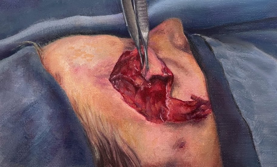 Oil painting of a facial laceration being repaired with forceps
