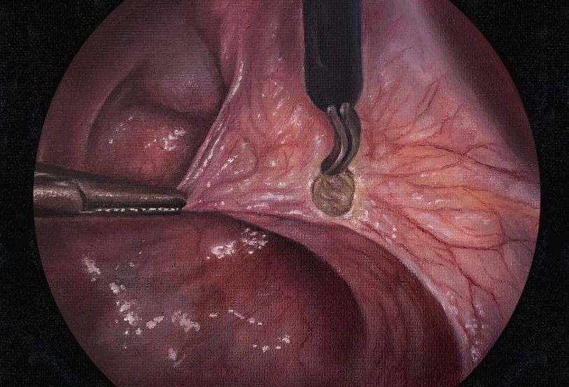 Oil painting of a laparoscopic view showing hemostasis