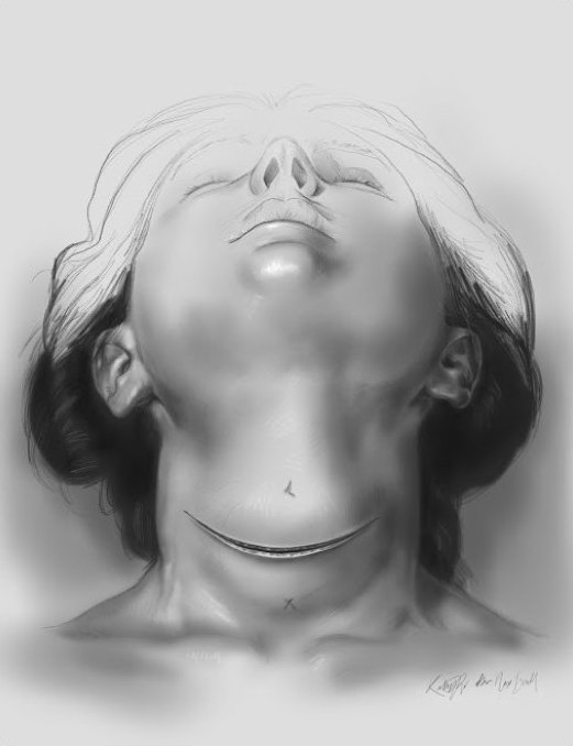 Patient with neck extended and a transverse incision for anterior neck surgery
